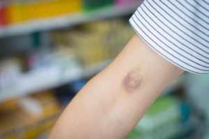 bruise نقص الصفيحات الدموية